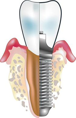 Implant 2