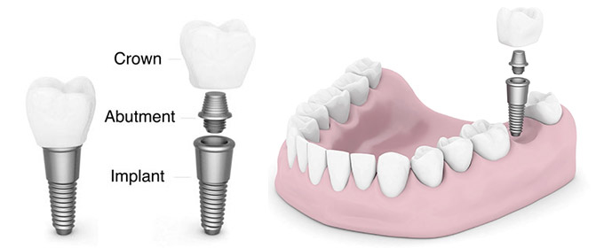 The-Go-to-Clinic-for-Dental-Implants-in-Langley﻿