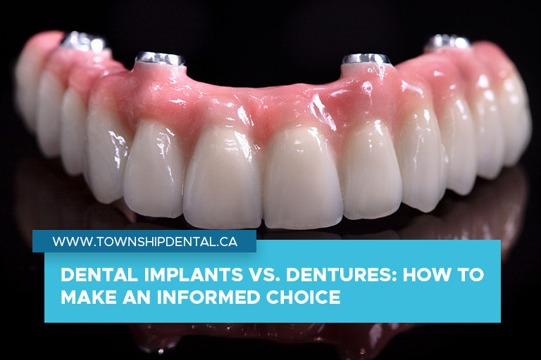 Dental Implants vs. Dentures How to Make an Informed Choice