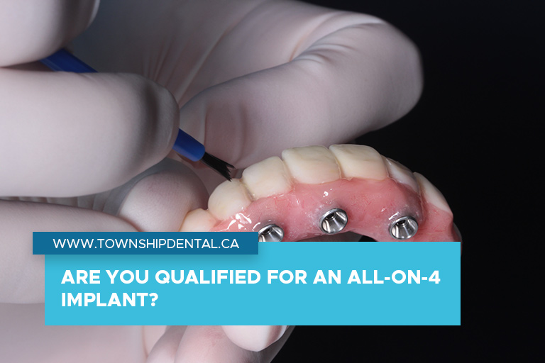 Are You Qualified for an All-on-4 Implant?