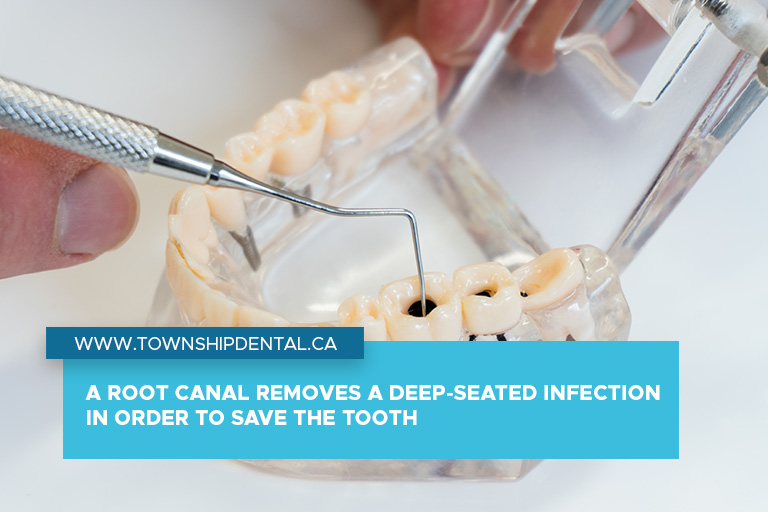A root canal removes a deep-seated infection in order to save the tooth