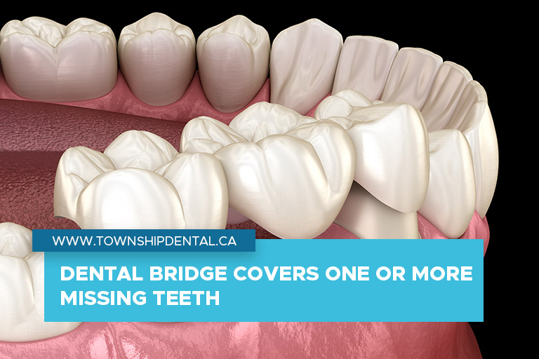 Dental bridge covers one or more missing teeth