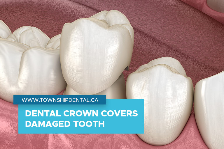 Dental crown covers damaged tooth