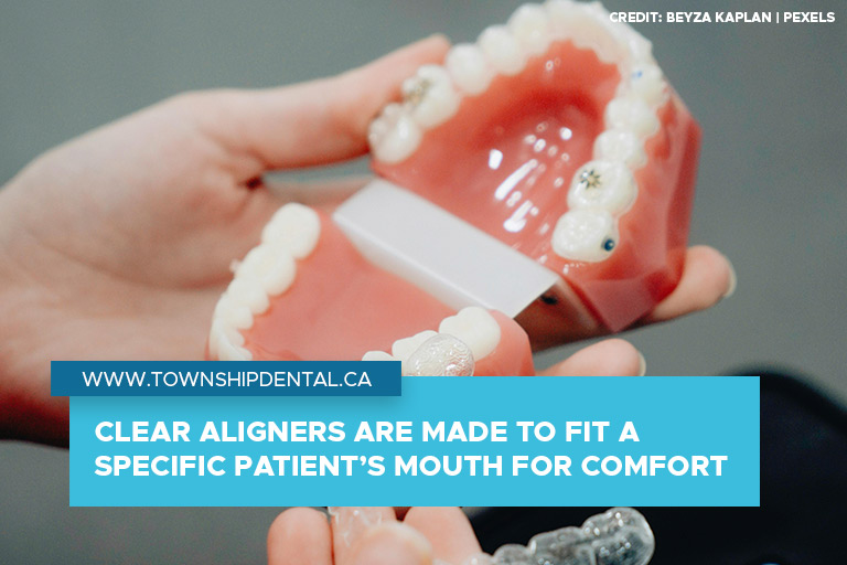 Clear aligners are made to fit a specific patient’s mouth for comfort