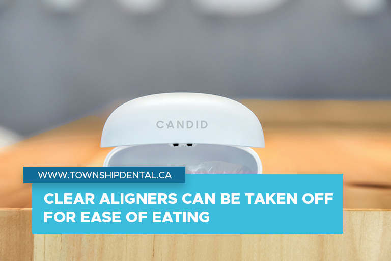 Clear aligners can be taken off for ease of eating