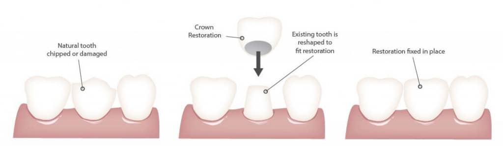 Dental Crowns And Bridges in Langley, BC