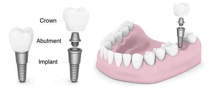 Dental Implants in Langley, BC