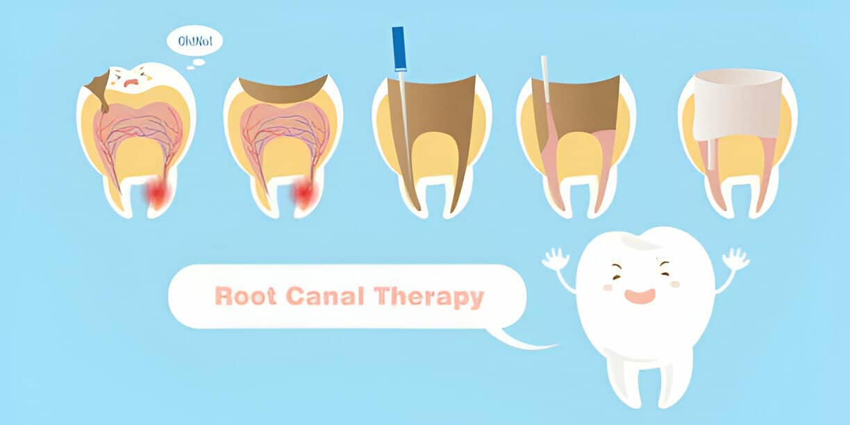 Root Canal Treatment in Langley