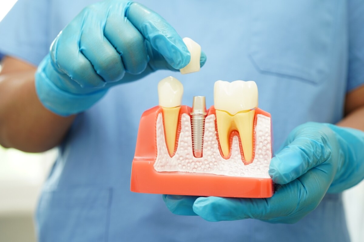 How Root Canal Therapy Can Save Your Natural Tooth